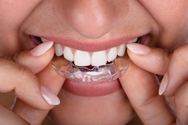 What Can I Expect When I Get Clear Aligners? [Ask an Orthodontist